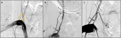 Second Generation Drug-Eluting Stents for Endovascular Treatment of Ostial Vertebral Artery Stenosis: A Single Center Experience